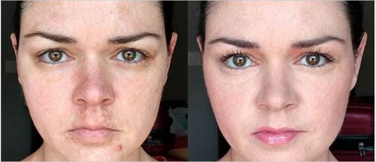 best makeup to cover melasma