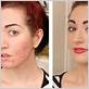 best cover up makeup for acne scars