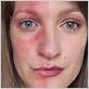 best makeup for covering rosacea