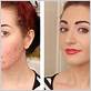 best makeup for acne scars, makeup for acne-prone skin, cover-up makeup, acne scar makeup tutorial