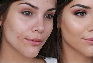 best pimple cover up makeup